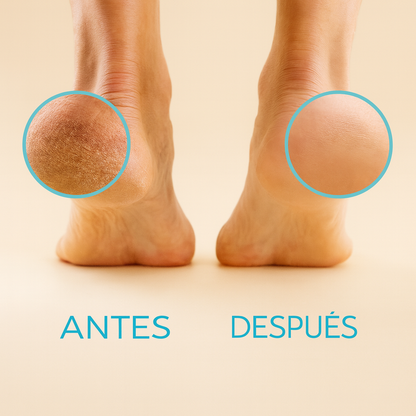 Removedor de callos